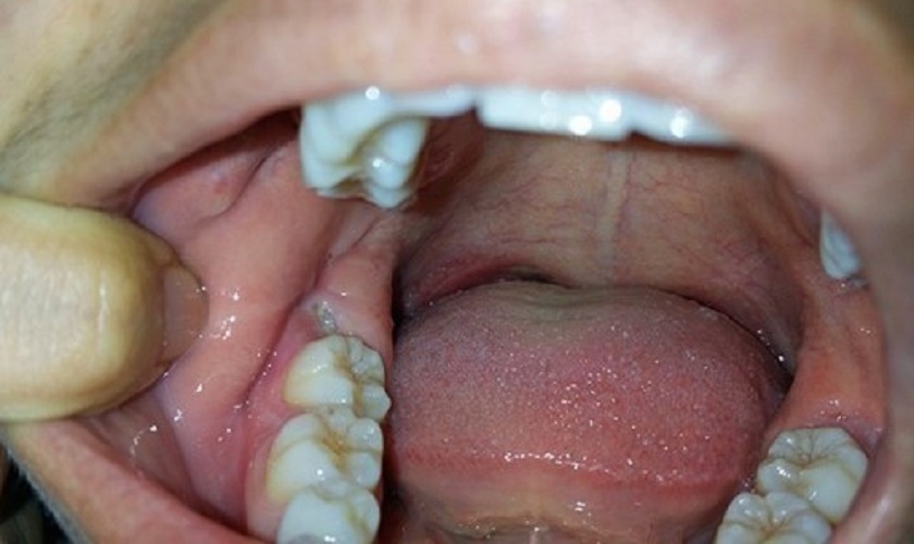 Mọc răng khôn là một trong những nguyên nhân gây sưng nướu