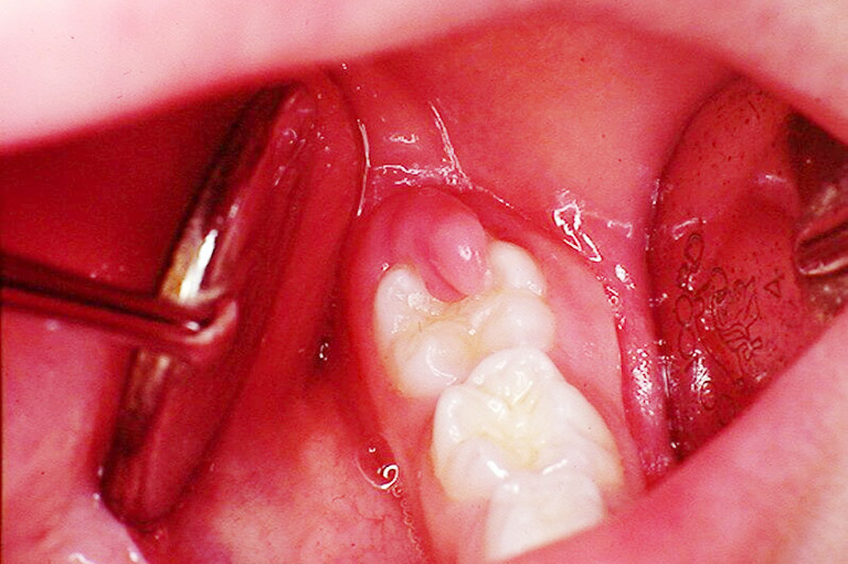 Răng khôn gây viêm nướu, đau nhức