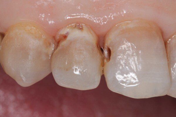 Răng bị sâu cũng sẽ gây rụng răng khi đang niềng 