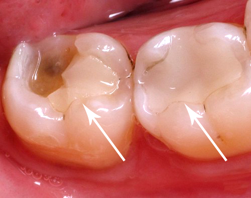 Trám răng sai kỹ thuật dẫn đến trình trạng miếng tám bị bong tróc