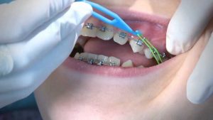 Những tai nạn khi niềng răng bạn có thể gặp phải và cách phòng tránh