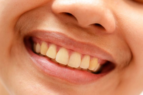 Răng ố vàng không chỉ gây mất thẩm mỹ mà còn ảnh hưởng đến sức khỏe răng miệng của bạn
