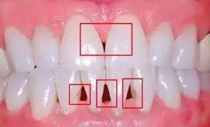 Nguyên nhân và cách khắc phục tình trạng tam giác nướu sau niềng răng