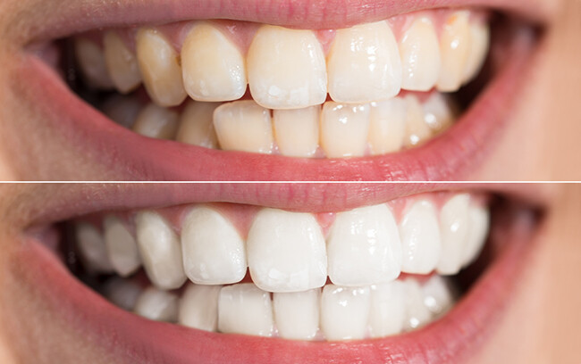 Tẩy trắng răng giúp bạn có một nụ cười tự tin hơn