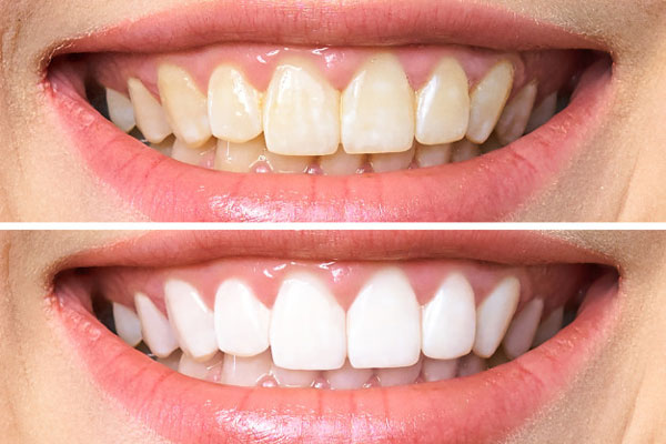 Hàm răng trắng đẹp sẽ giúp bạn tự tin hơn