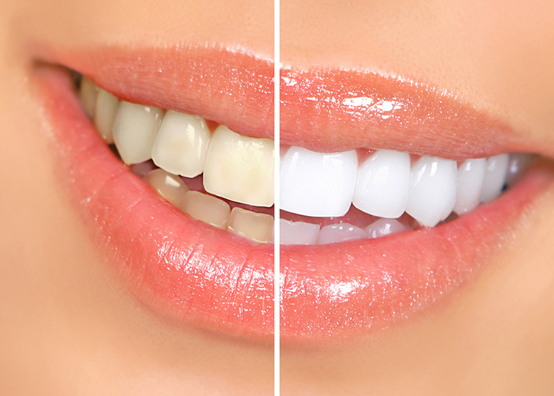 Răng sau khi được tẩy trắng tại Sea Dental