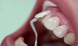 Trồng răng sứ có tháo ra được không?