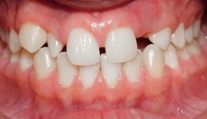 Nguyên nhân và cách khắc phục tình trạng thiếu răng bẩm sinh
