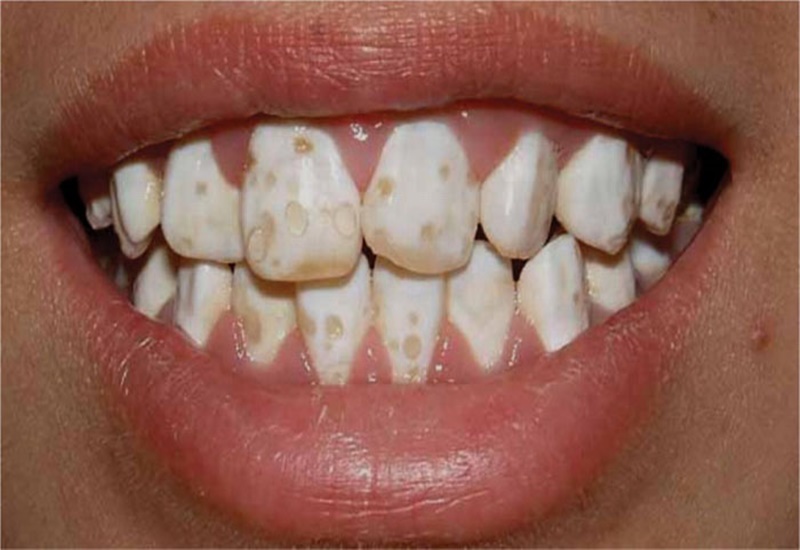 Thiếu sản men răng: Nguyên nhân và cách điều trị như thế nào?