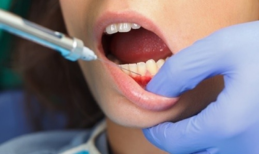 thuốc tê nha khoa trong nhổ răng