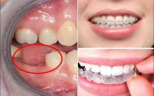 Nguyên nhân nào dẫn đến tình trạng tiêu xương răng khi đang niềng