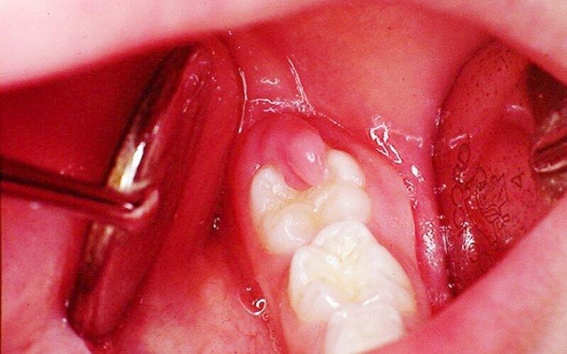 Cách khắc phục niềng răng bị lợi trùm