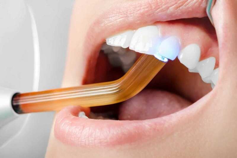 Giải đáp khi nào cần hàn răng và hàn răng được bao lâu?