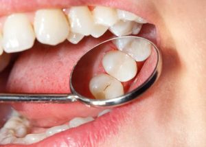 Quy trình trám răng cửa bị sâu bằng Composite