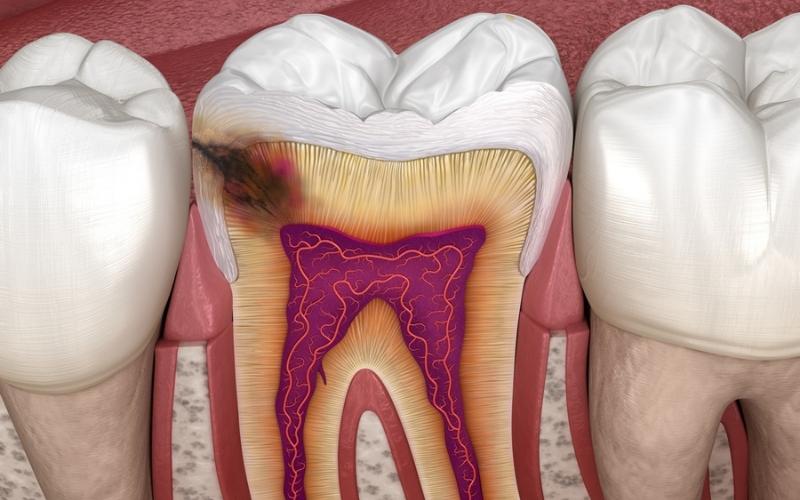 Nên trám răng sớm tránh gây ảnh hưởng lên răng