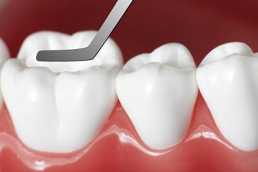 Cách xử lý khi trám răng rồi nhưng vẫn bị sâu tái phát