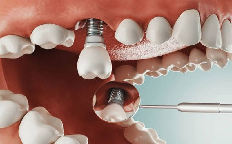 Răng Implant ngày càng được ưa chuộng