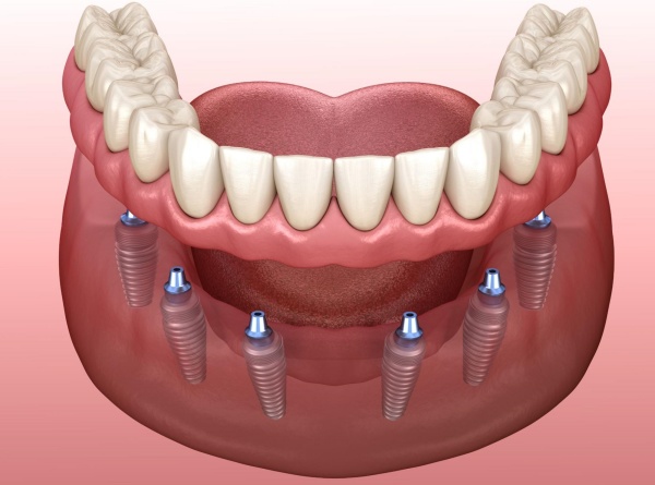 Cấy ghép răng số 6 bằng phương pháp implant