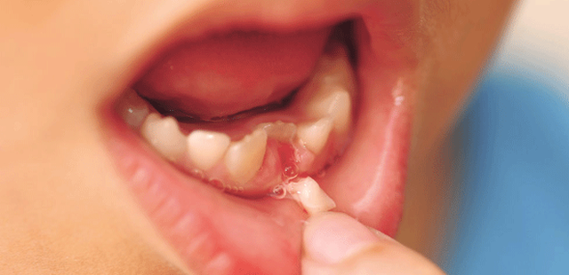 Trường hợp răng trẻ bị mọc lệch so với vị trí răng