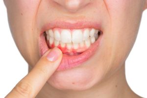 Viêm nướu răng nếu không được điều trị kịp thời sẽ nguy hiểm hơn bạn nghĩ