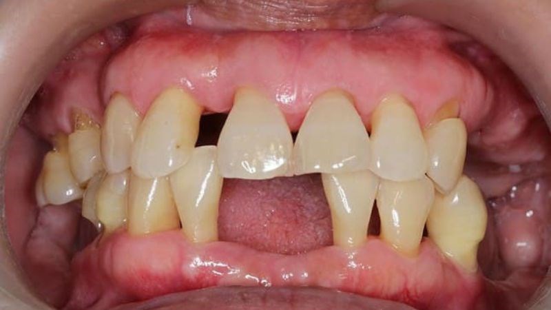 Mất răng - một trong những biến chưng nặng nề của viêm nướu răng