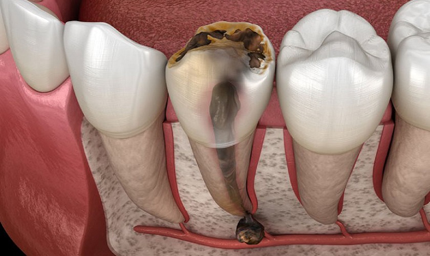 tác hại viêm tủy răng