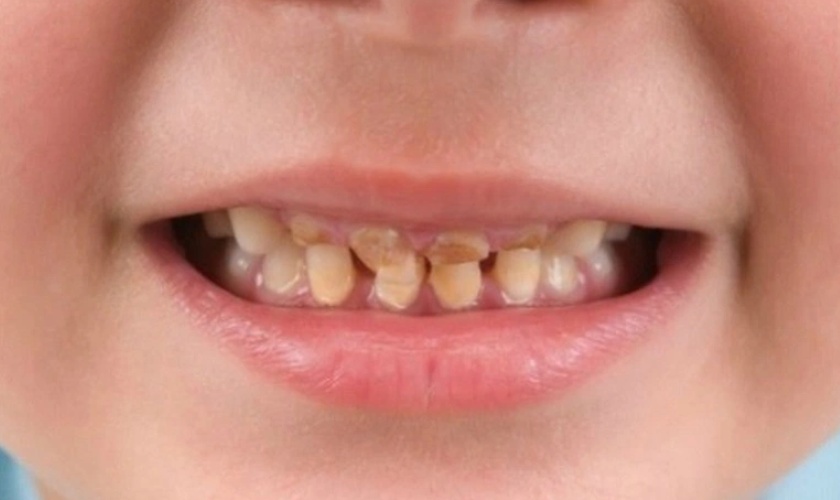 bệnh ăn mòn chân răng ở trẻ em