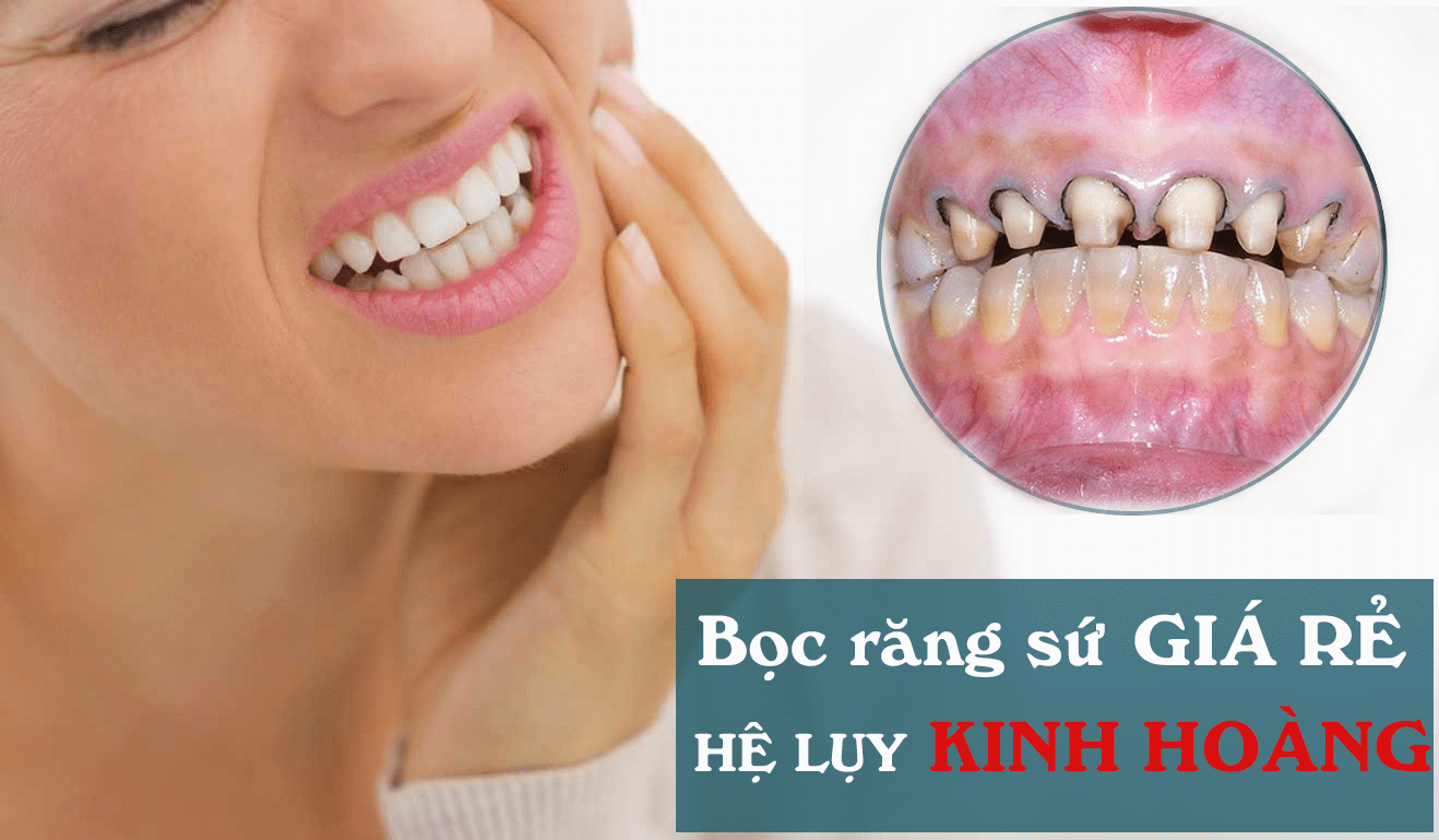 8 hậu quả bọc răng sứ giá rẻ mà không phải ai cũng biết