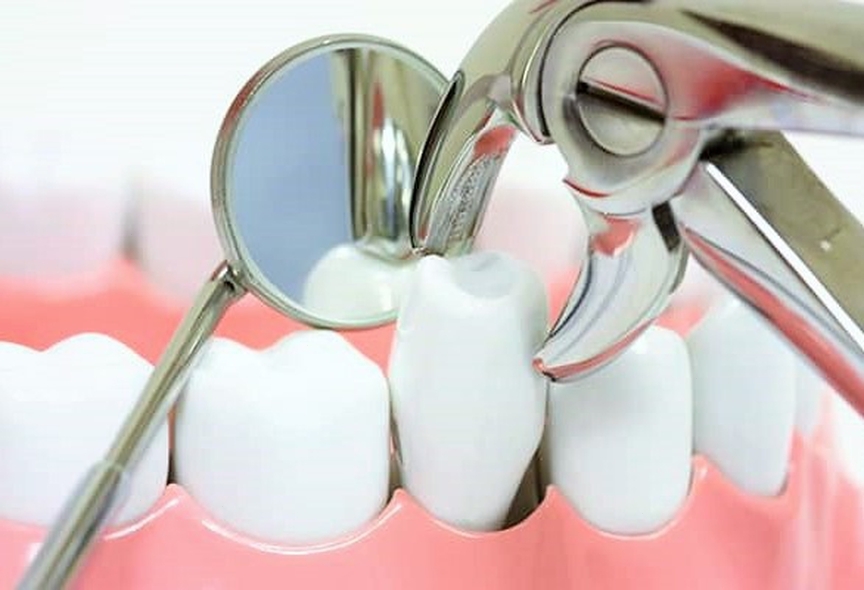 Nhổ răng nào đau nhất và cách giảm đau nhanh chóng