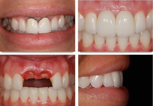 Tùy vào tay nghề bác sĩ việc trồng răng cửa sẽ có thể giảm tối thiểu đau đớn