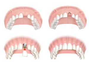 Trồng răng cửa có đau không? Các phương pháp phổ biến
