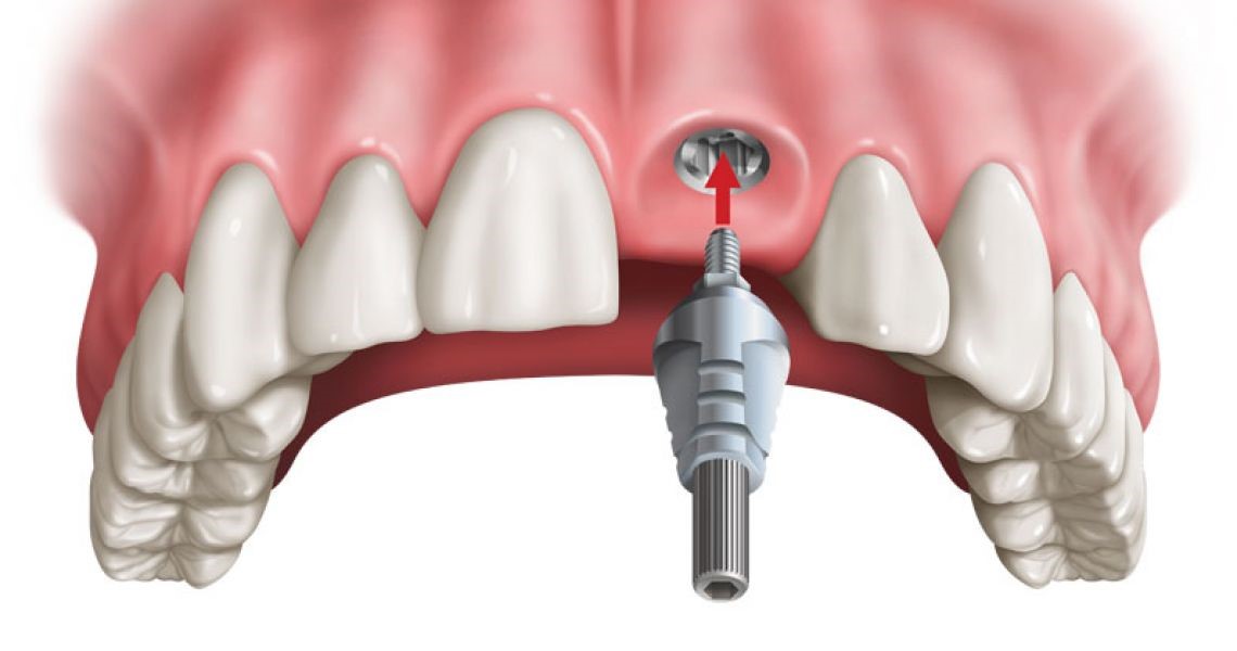 Cấy ghép implant phục hình răng cửa