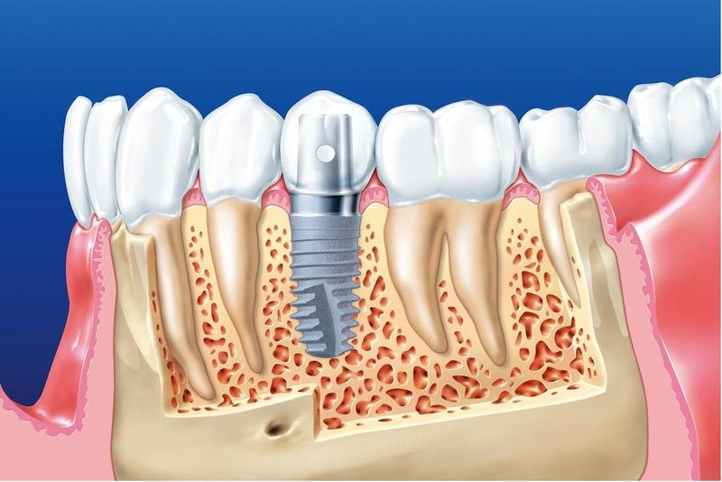 trụ răng implant