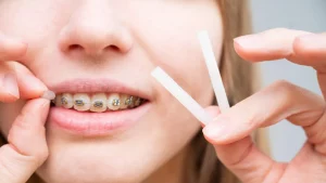Bí quyết sử dụng sáp nha khoa giảm đau hiệu quả khi niềng răng