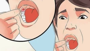 Bao lâu thì lỗ hổng sau nhổ răng đầy lại? Diễn biến lành thương sau nhổ răng