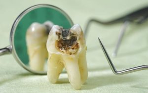Bảng giá nhổ răng sâu cho từng trường hợp tại Nha khoa Sea Dental