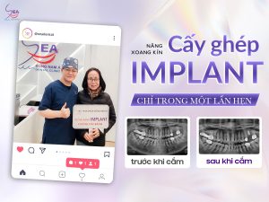 5 lợi ích không ngờ của cấy ghép Implant