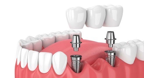 Khám phá quy trình cấy ghép Implant từ A đến Z tại Nha khoa Sea Dental