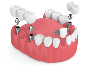5 cách để trồng răng Implant với chi phí tiết kiệm