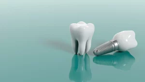 Rủi ro và nhược điểm khi trồng răng Implant mà không phải ai cũng biết