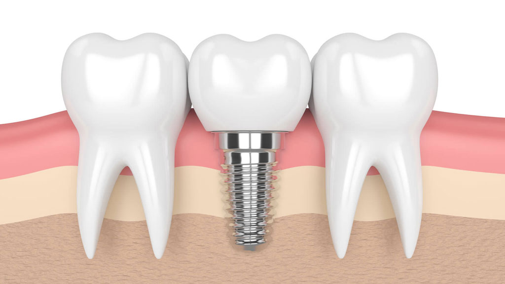 5 nhược điểm không thể bỏ qua khi quyết định trồng răng Implant