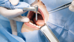 Lựa chọn và đánh đổi khi quyết định trồng răng Implant