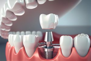 Mặt trái của việc trồng răng Implant bạn cần cân nhắc kỹ